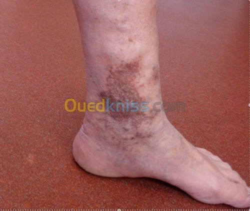 Traitement des varices sans chirurgie