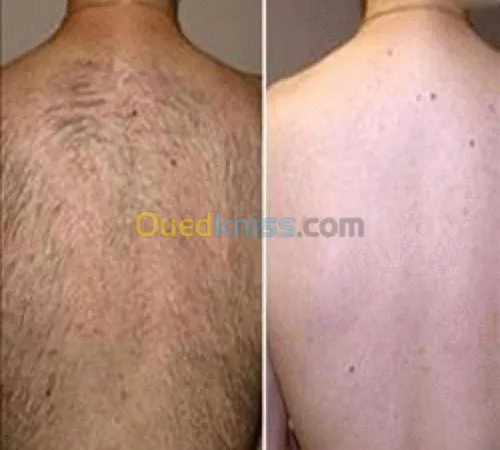 Lasers dermatologique 