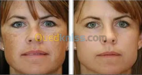 Lasers dermatologique 