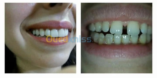 VENEERS