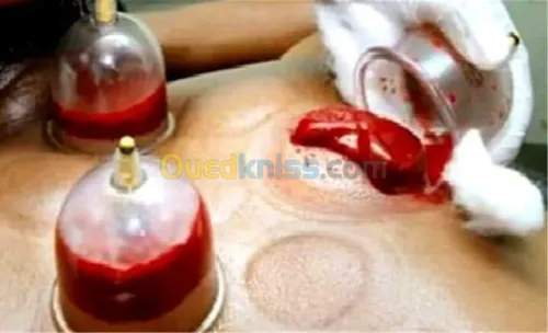 التداوي بالحجامة و لسع النحل