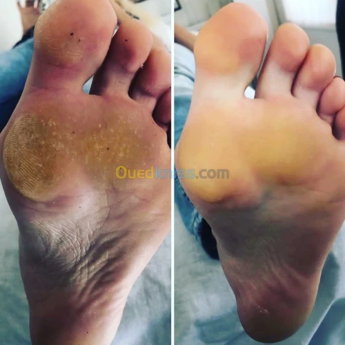 Pedicure madical