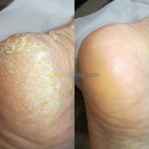 Pedicure madical