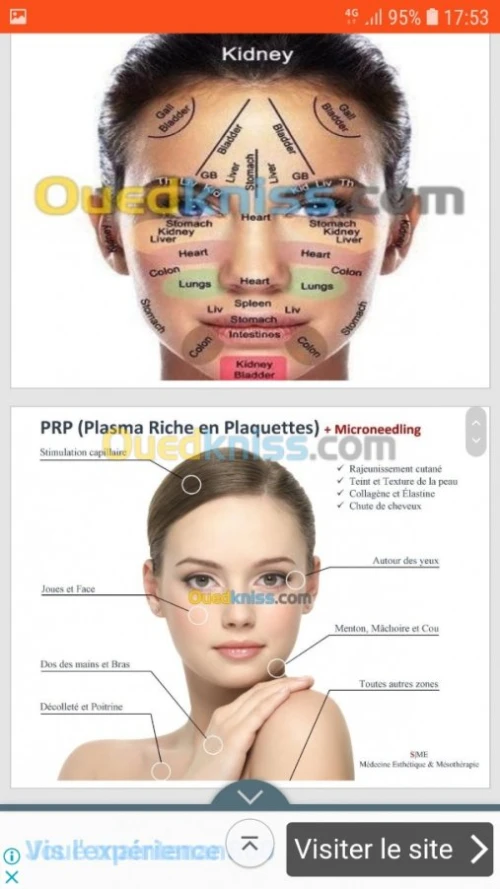 Acupuncture Hernie Discale & Cervical 