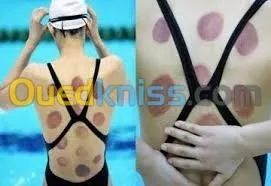 Acupuncture Hernie Discale & Cervical 