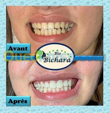 Blanchiment Dentaire Pro