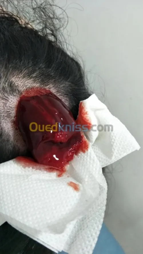 حجامة وأعشاب طبية و التدليك الطبيعي