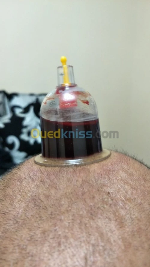 حجامة وأعشاب طبية و التدليك الطبيعي