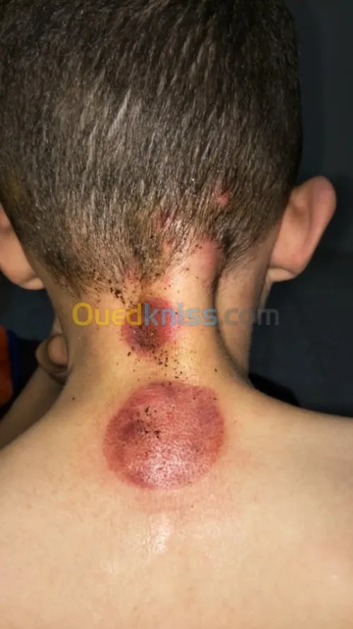 حجامة وأعشاب طبية و التدليك الطبيعي