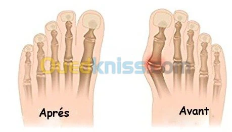 correcteur d'orteils HALLUX VALGUS