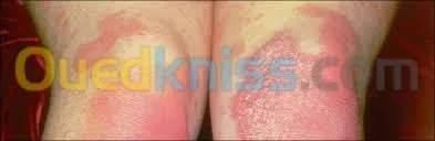 Matériel de photothérapie à UV