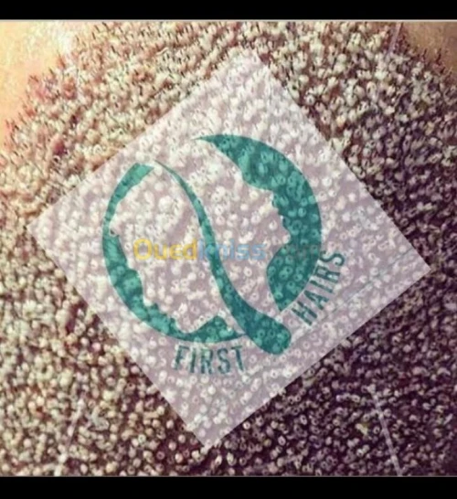 Greffe de Cheveux /زراعة الشعر الجزائر