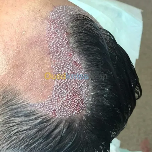 Greffe de Cheveux /زراعة الشعر الجزائر