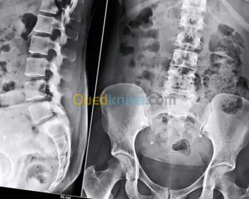 Réparations des tables radiologiques