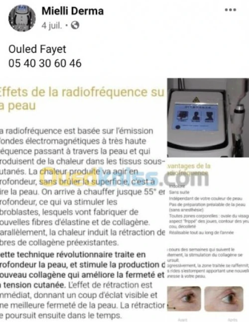 Mésothérapie épilation définitive 