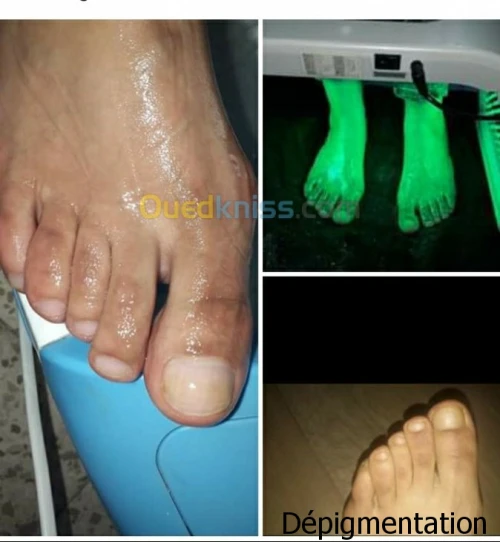 Mésothérapie épilation définitive 