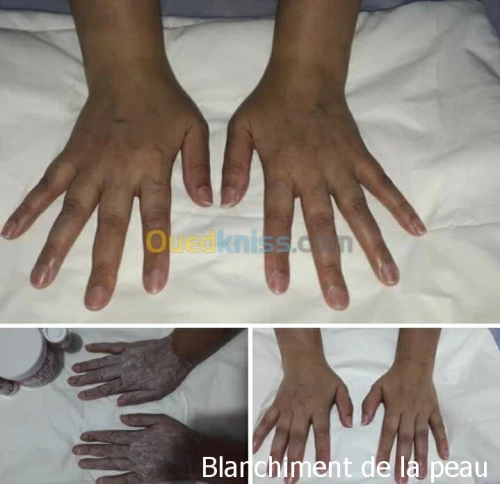 Mésothérapie épilation définitive 