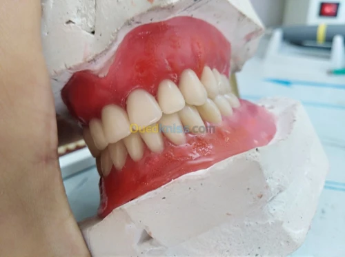 Prothèse dentaire amovible 