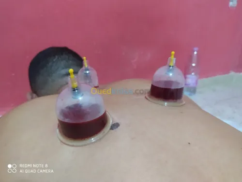 حجامة العلاجية و الوقائية  Cupping the
