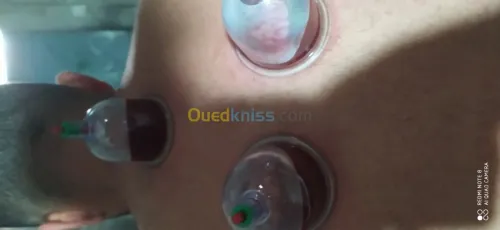 حجامة العلاجية و الوقائية  Cupping the