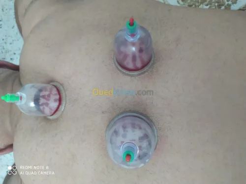 حجامة العلاجية و الوقائية  Cupping the