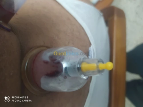 حجامة العلاجية و الوقائية  Cupping the