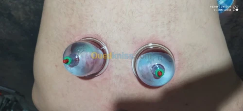 حجامة العلاجية و الوقائية  Cupping the