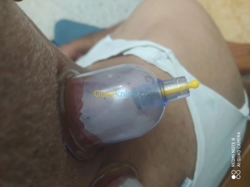 حجامة العلاجية و الوقائية  Cupping the
