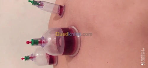 حجامة العلاجية و الوقائية  Cupping the
