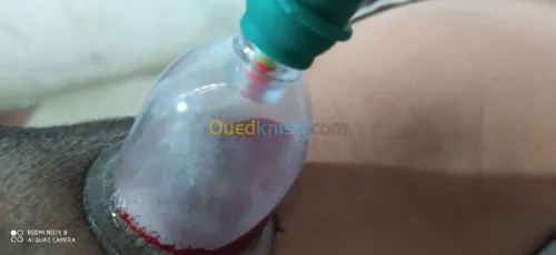 حجامة العلاجية و الوقائية  Cupping the
