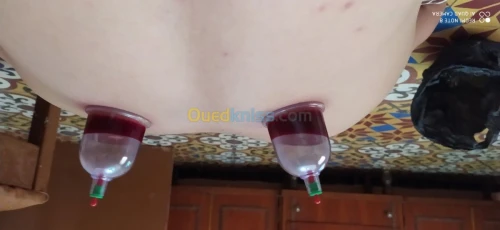 حجامة العلاجية و الوقائية  Cupping the
