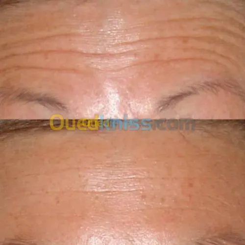  Botox filer microneedling et mesother
