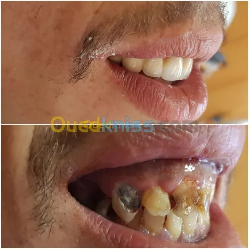 ODf / Hollywood smile /Implantation 