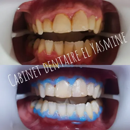 ODf / Hollywood smile /Implantation 