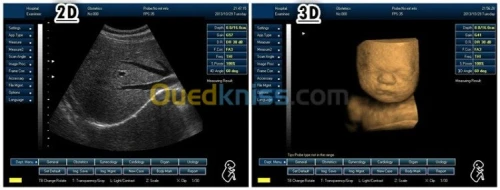 Echographie de diagnostic à ultrasons 