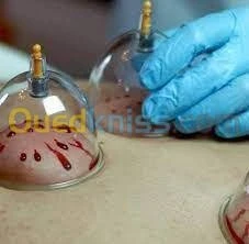 hijama حجامة
