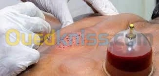 hijama حجامة