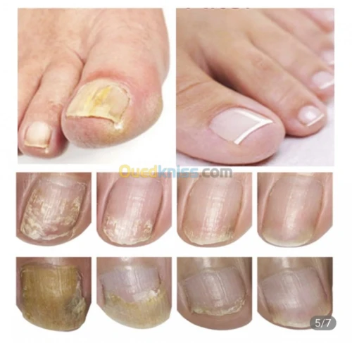 Éliminer la mycose des ongles