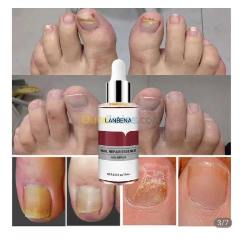 Éliminer la mycose des ongles