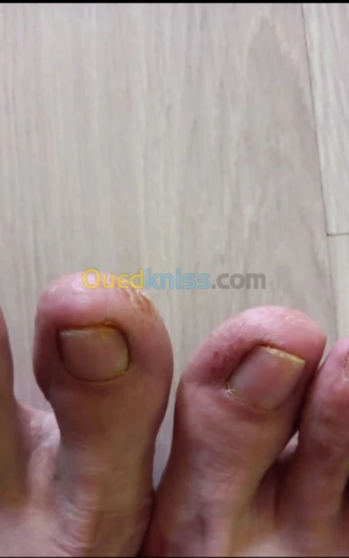 Éliminer la mycose des ongles