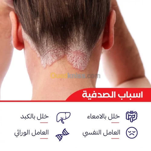 علاج الصدفية و الاكزيما