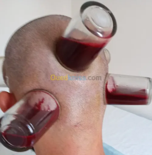 الحجامة الوقائية والعلاجية (رجال) 