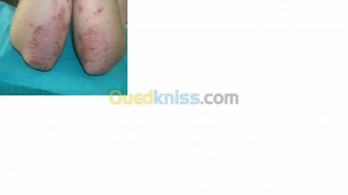 Maladie de la peau (Psoriasis)