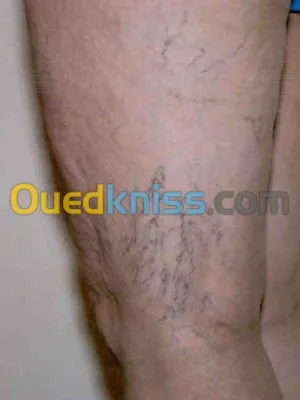Varices de jambe - Nouvelles Therapies