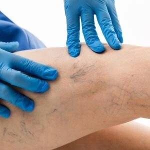 Bas varices 