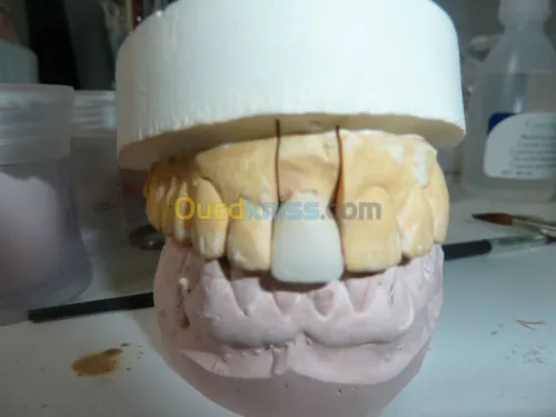 prothese dentaire, soins, odf,