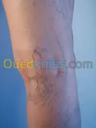 les traitements des varices