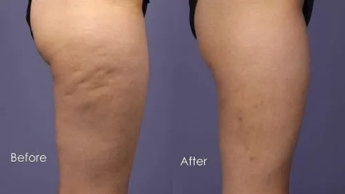 Crème anti cellulite soin du corps