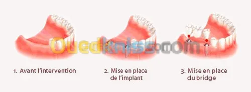 Implant dentaire et chirurgie buccale