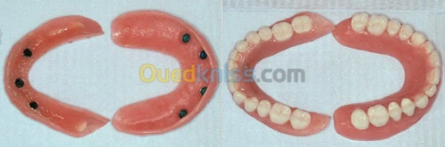 Implant dentaire et chirurgie buccale